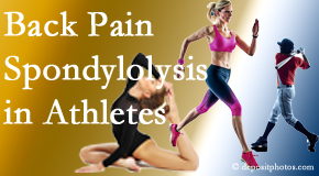 Layden Chiropractic treats athletes of all levels and all ages who have back pain using spinal manipulation, nutrition and specific exercise.
