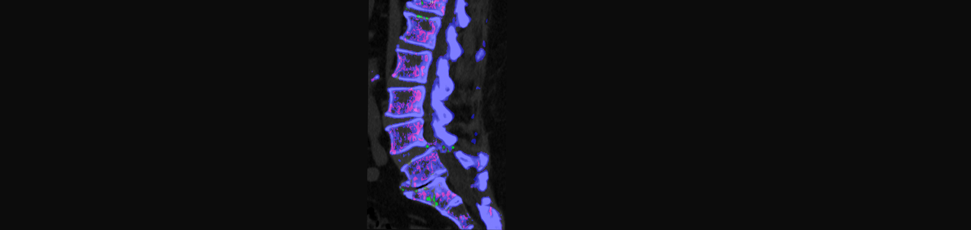 Layden Chiropractic is aware that inflammatory spinal gout is a differential diagnosis to consider for patients who present with back pain and other spine related symptoms.