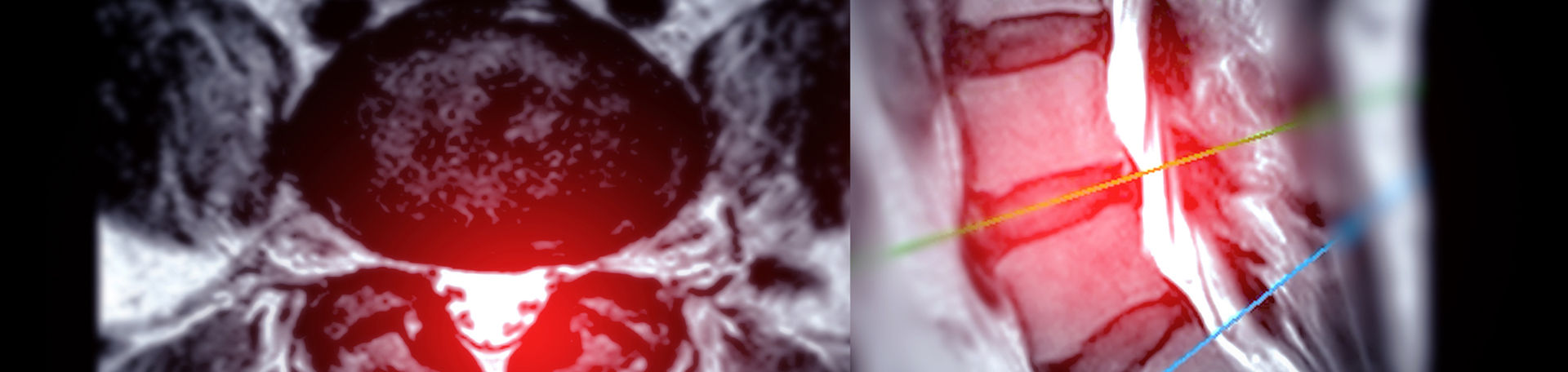 Plainville back pain imaging and exercise