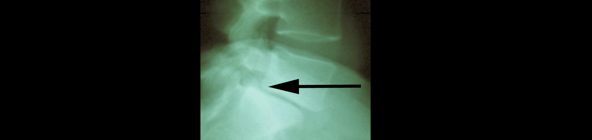 Plainville spondylolisthesis 