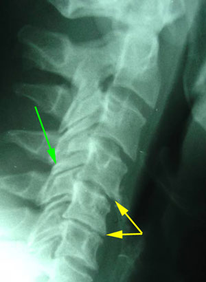 disc degeneration treated at Layden Chiropractic