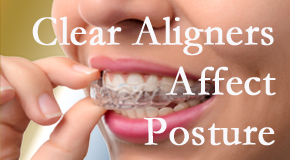 Clear aligners influence posture which Plainville chiropractic helps.