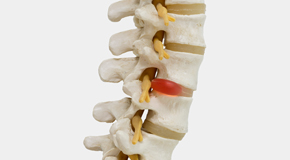 Plainville chiropractic conservative care helps even giant disc herniations go away