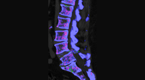 Layden Chiropractic is aware that inflammatory spinal gout is a differential diagnosis to consider for patients who present with back pain and other spine related symptoms.