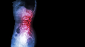 Plainville Chiropractic Care of Spondylolisthesis 