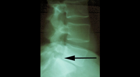 Plainville spondylolisthesis 