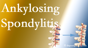 Layden Chiropractic offers gentle chiropractic spinal manipulation in the form of Cox Technic for ankylosing spondylitis management.
