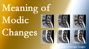 Layden Chiropractic sees many back pain and neck pain patients who bring their MRIs with them to the office. Modic changes are often seen. 