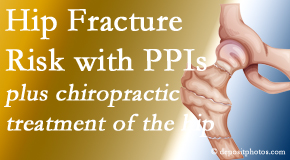 Layden Chiropractic shares new research describing increased risk of hip fracture with proton pump inhibitor use. 