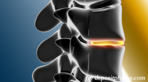 Plainville degenerative spinal changes 