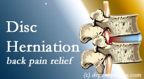 Layden Chiropractic uses non-surgical treatment for relief of disc herniation related back pain. 