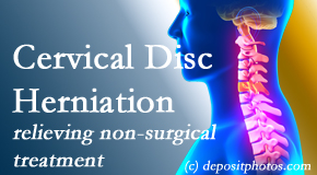 Layden Chiropractic offers the Cox® Technic spinal manipulation to treat cervical radiculopathy and avert surgery. 