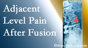 Layden Chiropractic offers relieving care non-surgically to back pain patients suffering with adjacent level pain after spinal fusion surgery.