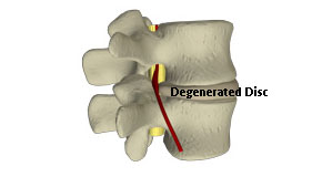 degenerated disc in the lower back