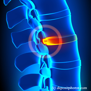 picture of lumbar Plainville disc herniation