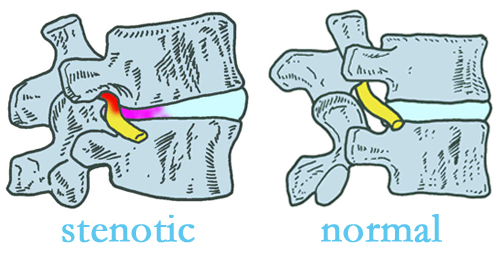 Plainville stenotic and normal spinal discs