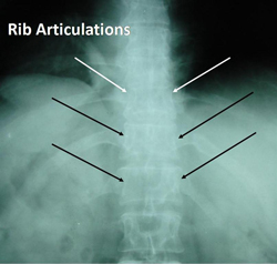 thoracic spine rib attachment